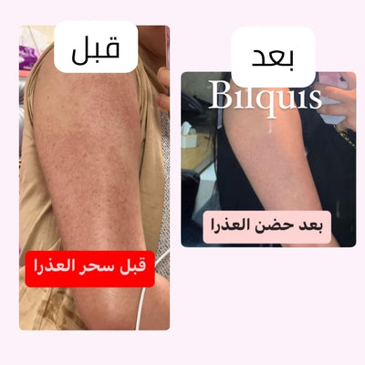 قبل وبعد – جلد الإوزة على الذراع