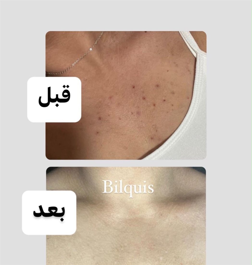 نتيجة قبل وبعد للجسم – بلقيس