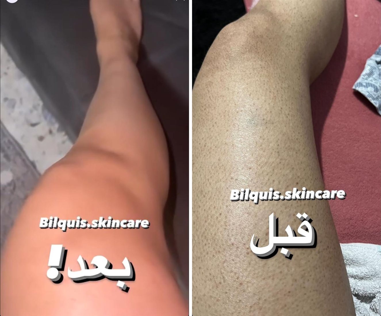 قبل وبعد – جلد الإوزة على الرجل